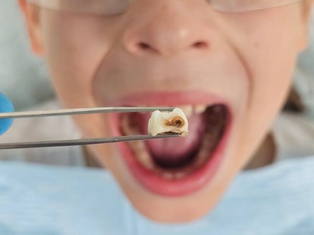 Best Emergency Dental Care for Broken or Chipped Teeth in Mount Holly, NC